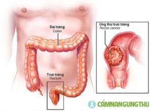 ung thư trực tràng là gì Cẩm Nang Ung Thư