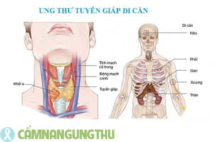 ung-thu-tuyen-giap-di-can-co-nguy-hiem-khong