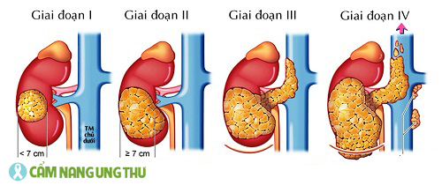 cac-giai-doan-ung-thu-gan