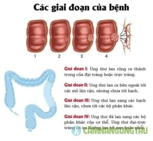 cac-giai-doan-cua-ung-thu-dai-trang-1