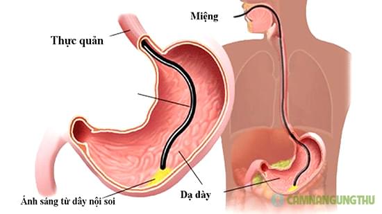 xet-nghiem-ung-thu-da-day-bang-noi-soi